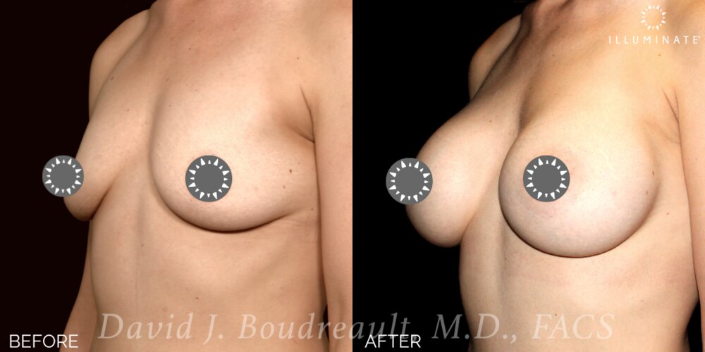 Breast Augmentation Before & After Image