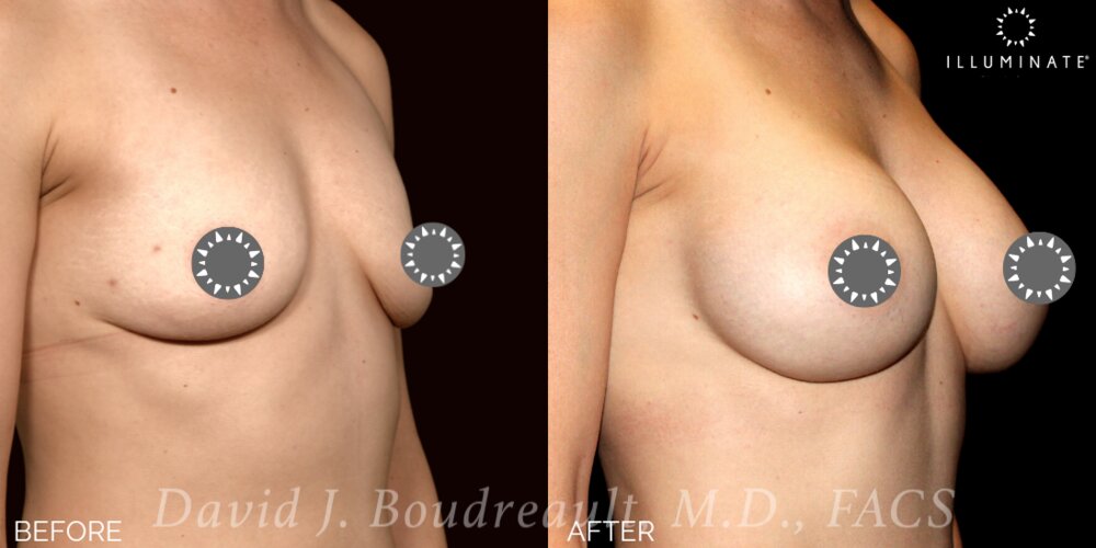 Breast Augmentation Before & After Image