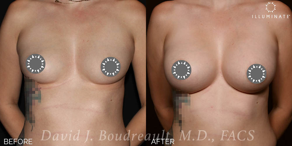 Breast Augmentation Before & After Image