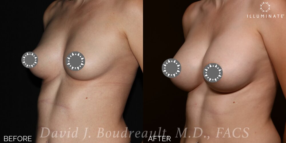 Breast Augmentation Before & After Image