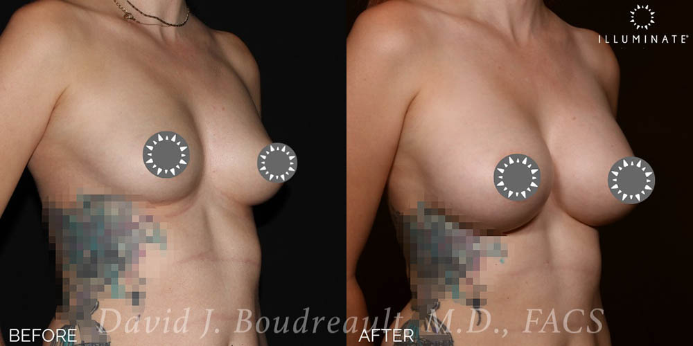 Breast Augmentation Before & After Image