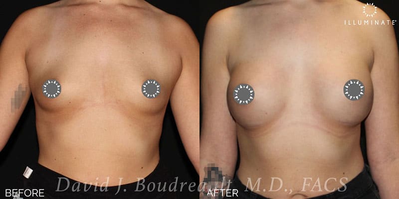 Breast Augmentation Before & After Image