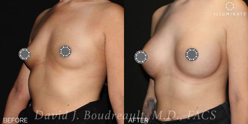 Breast Augmentation Before & After Image