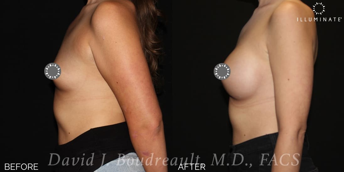 Breast Augmentation Before & After Image