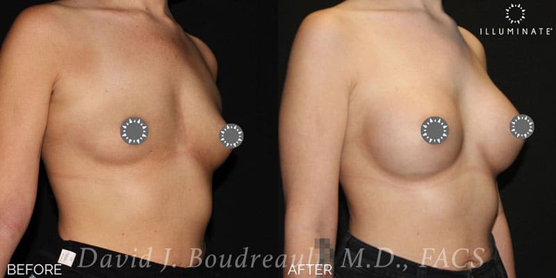 Breast Augmentation Before & After Image