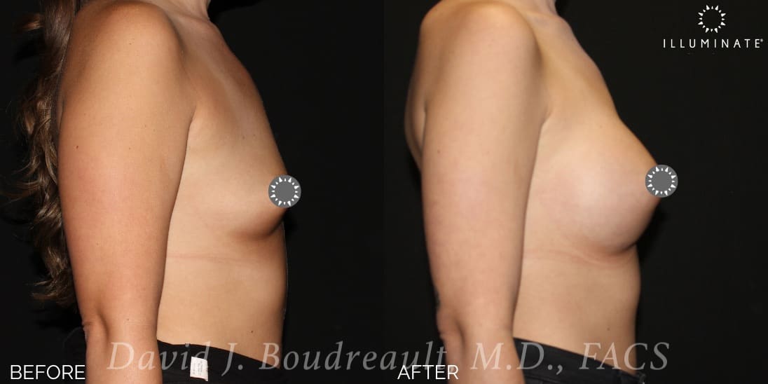 Breast Augmentation Before & After Image