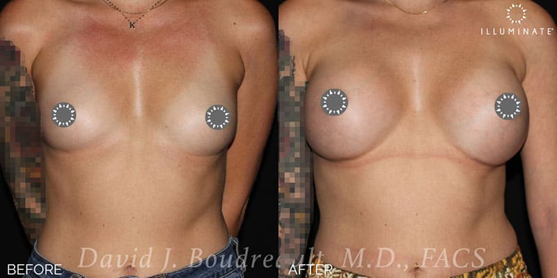 Breast Augmentation Before & After Image