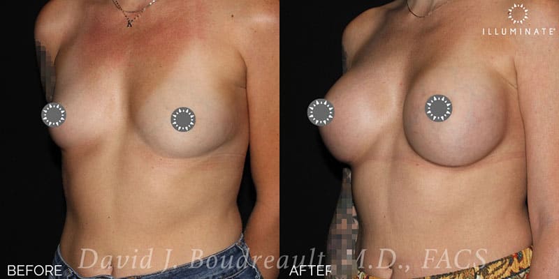 Breast Augmentation Before & After Image