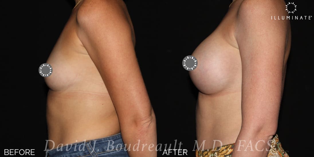 Breast Augmentation Before & After Image