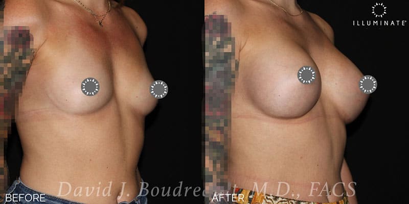 Breast Augmentation Before & After Image