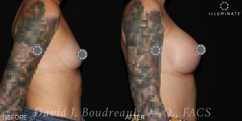 Breast Augmentation Before & After Image