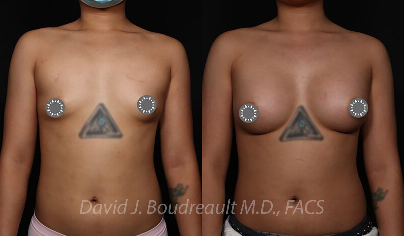 Breast Augmentation Before & After Image