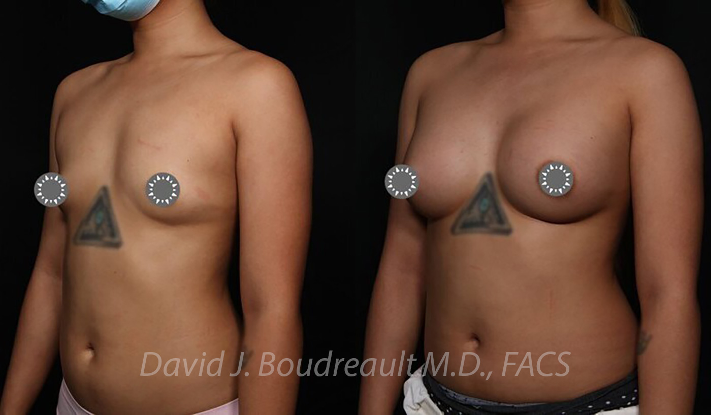 Breast Augmentation Before & After Image