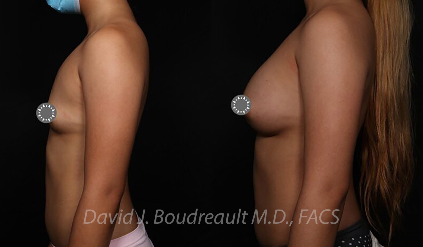 Breast Augmentation Before & After Image