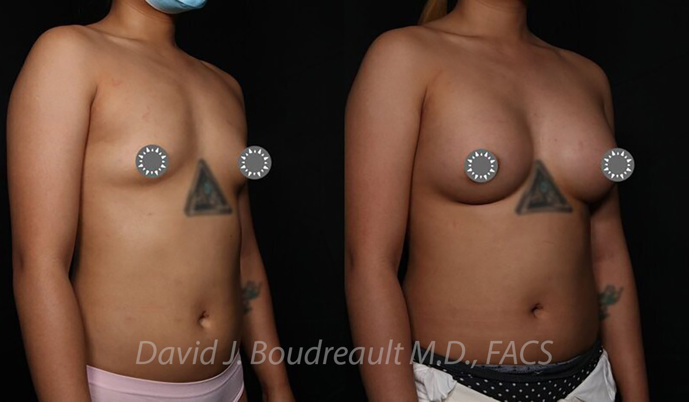 Breast Augmentation Before & After Image