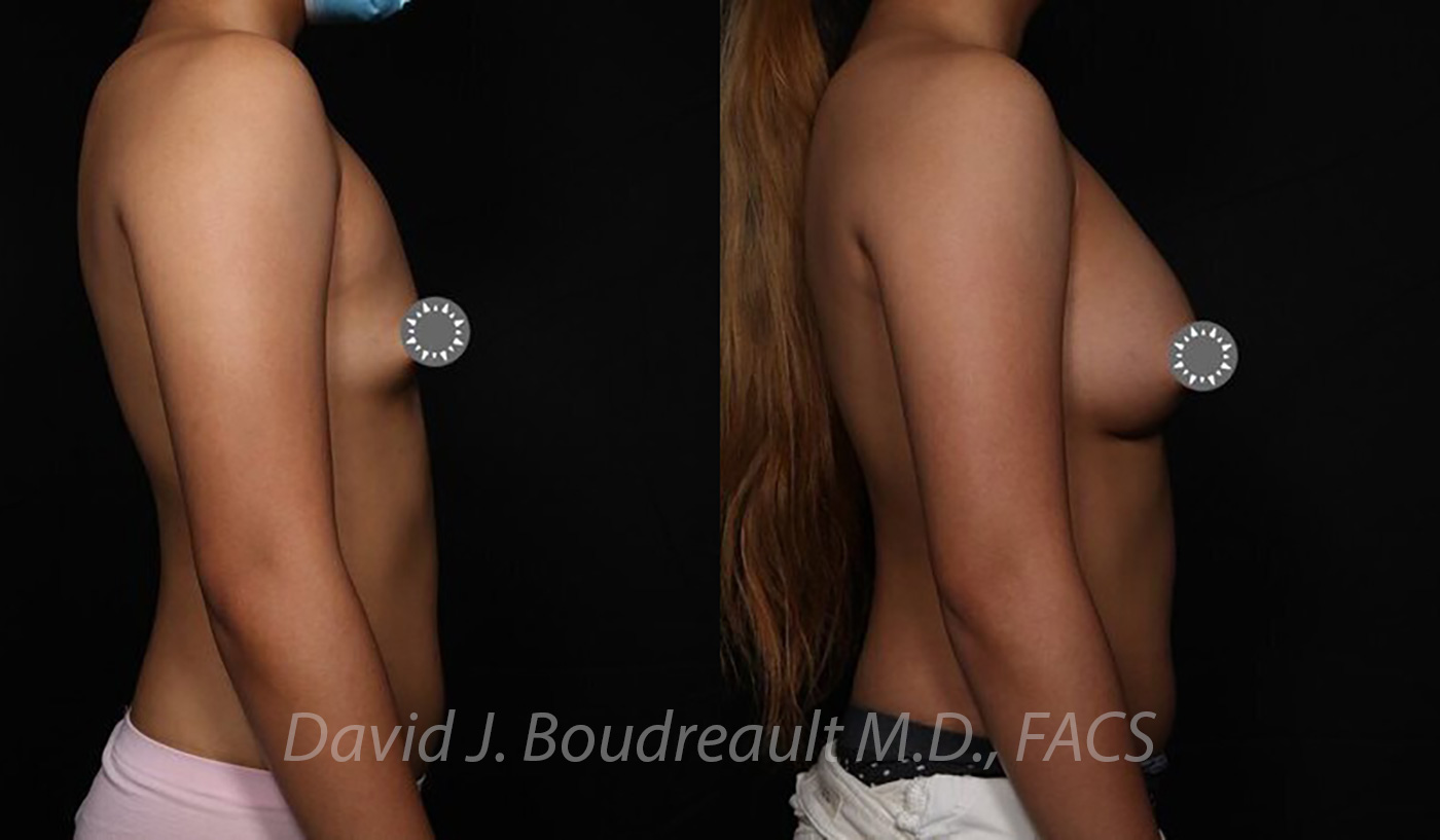 Breast Augmentation Before & After Image