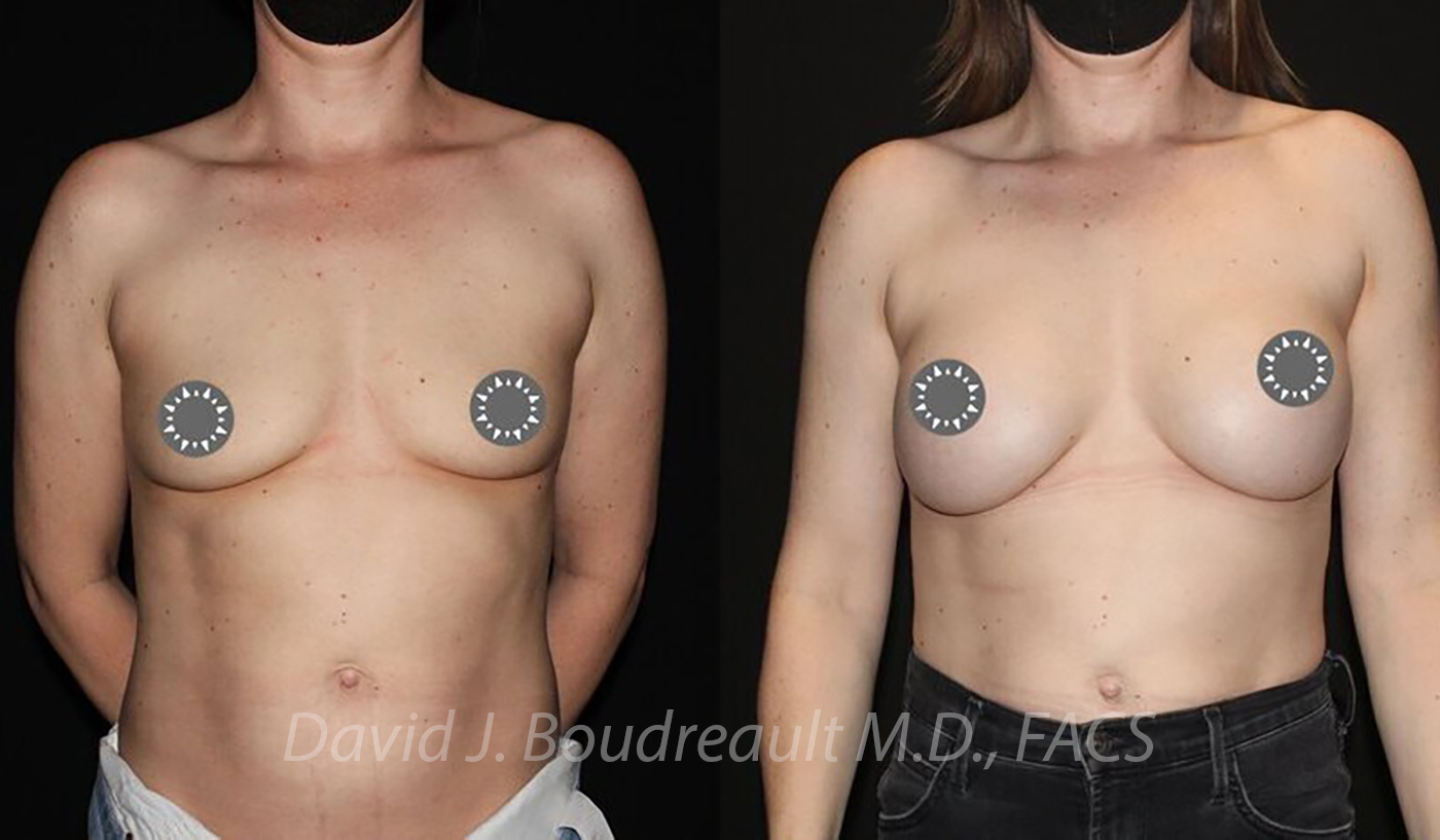 Breast Augmentation Before & After Image