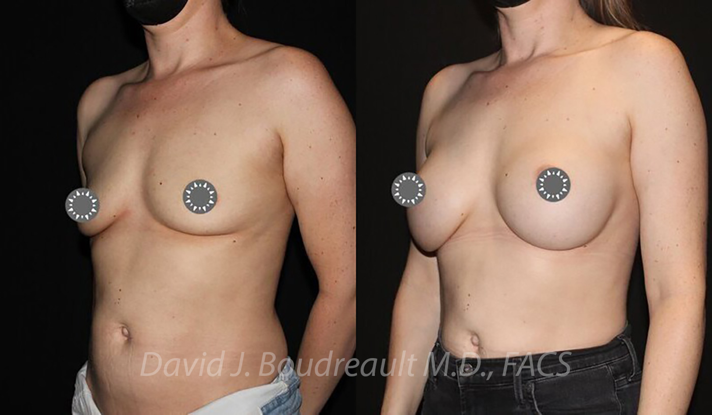 Breast Augmentation Before & After Image