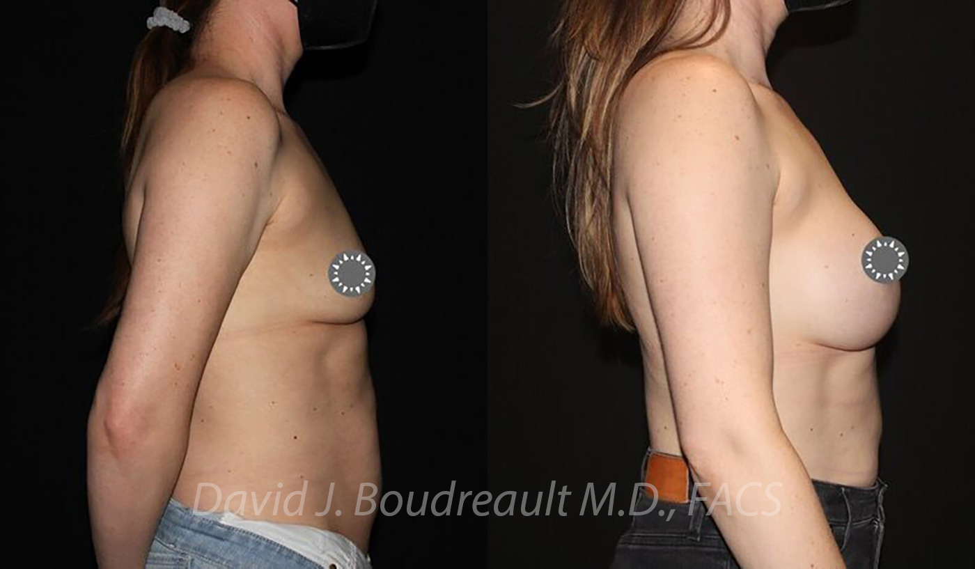 Breast Augmentation Before & After Image