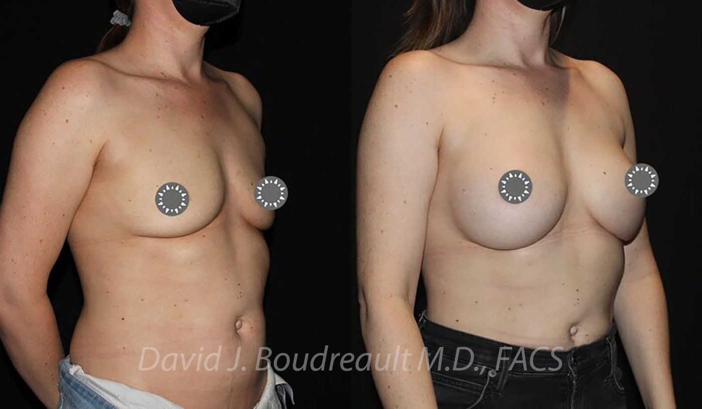 Breast Augmentation Before & After Image