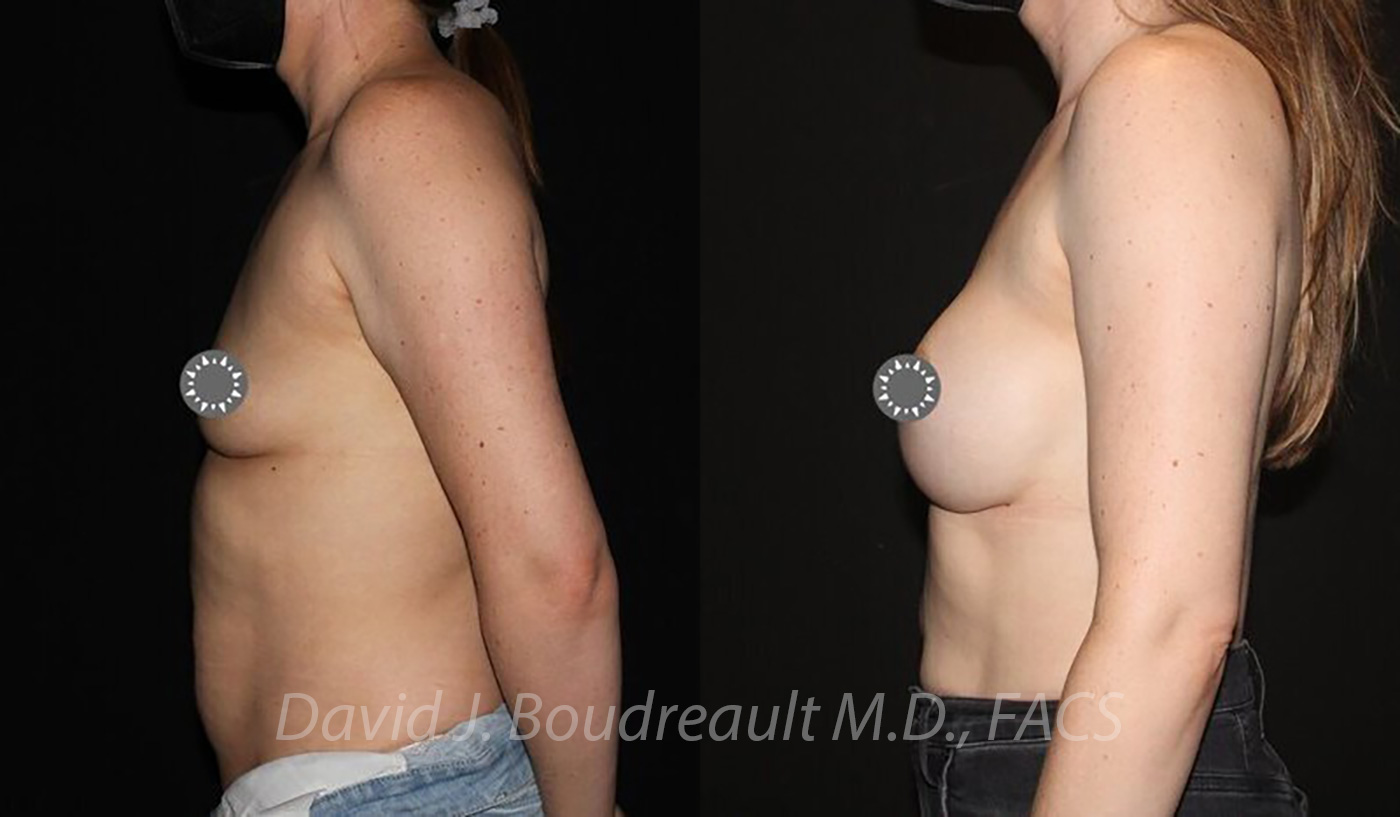 Breast Augmentation Before & After Image