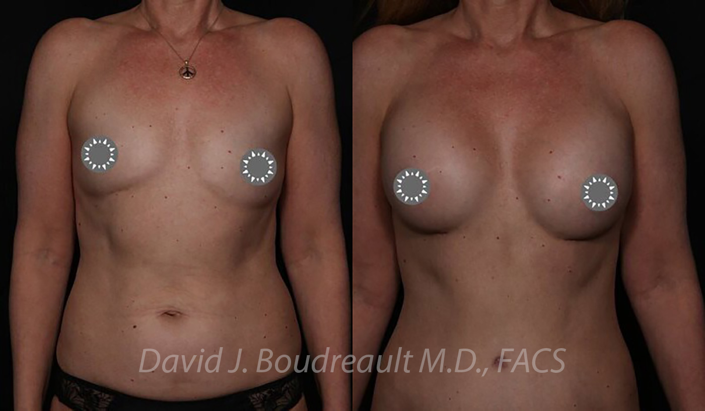Breast Augmentation Before & After Image