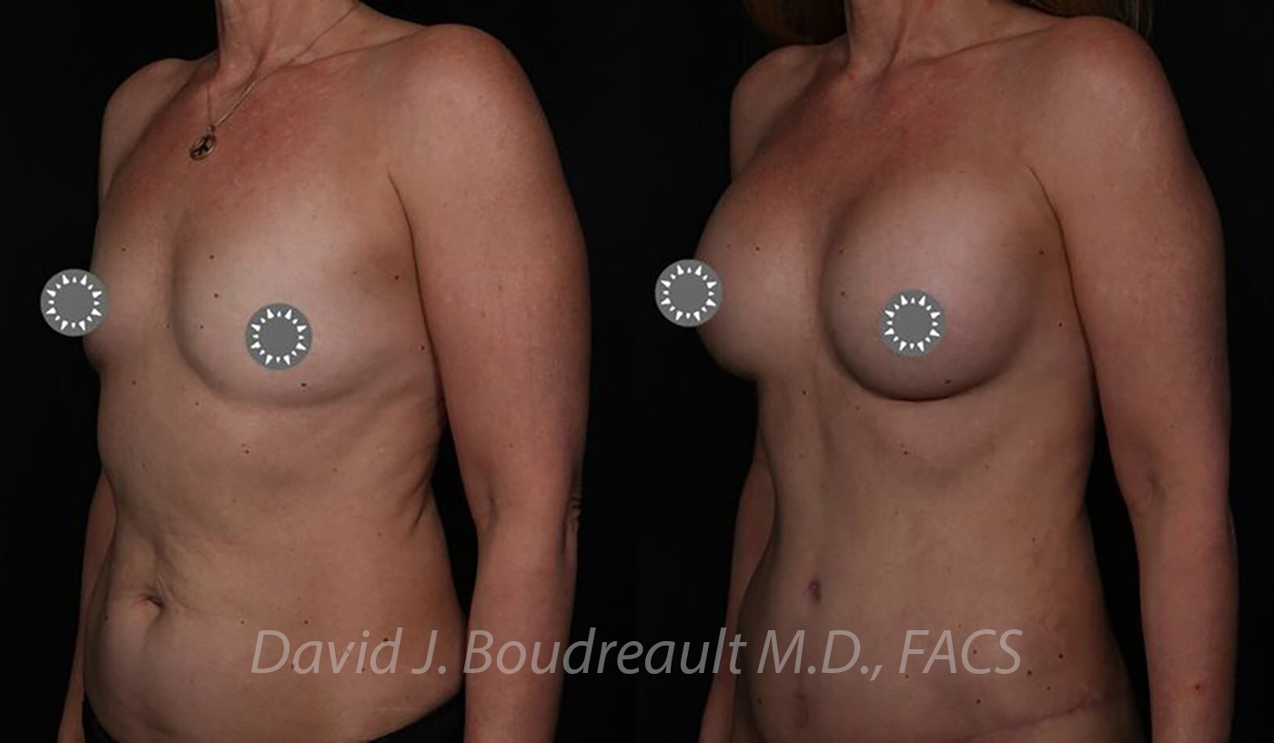 Breast Augmentation Before & After Image