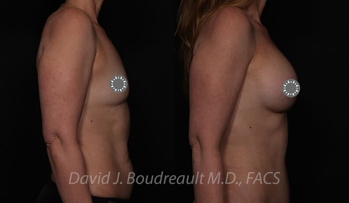 Breast Augmentation Before & After Image
