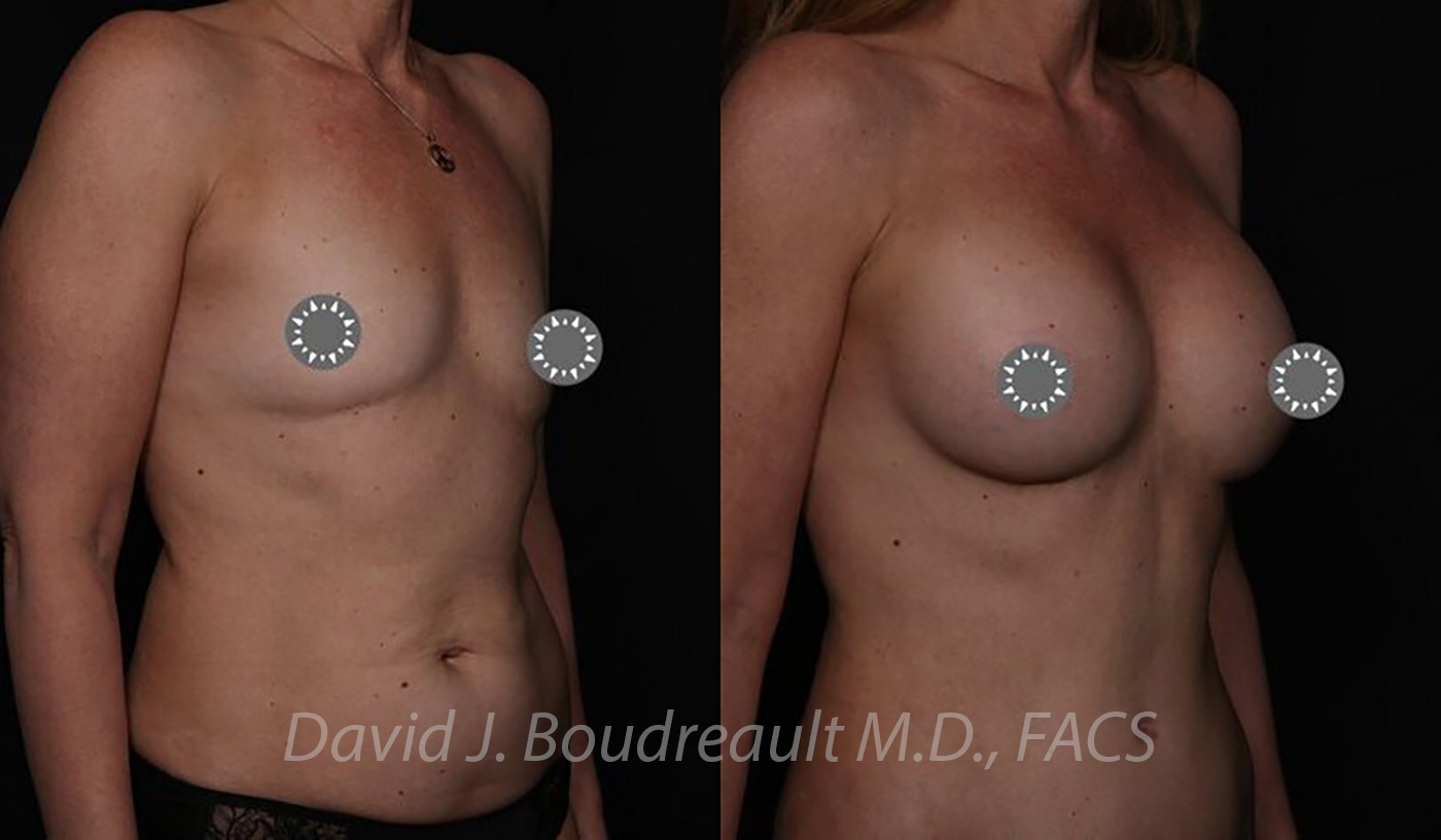 Breast Augmentation Before & After Image
