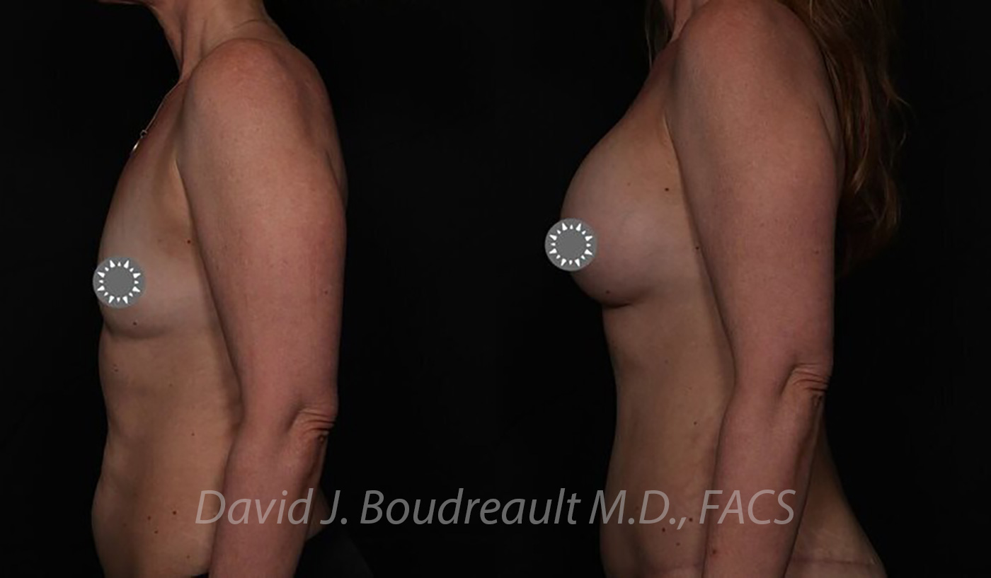 Breast Augmentation Before & After Image