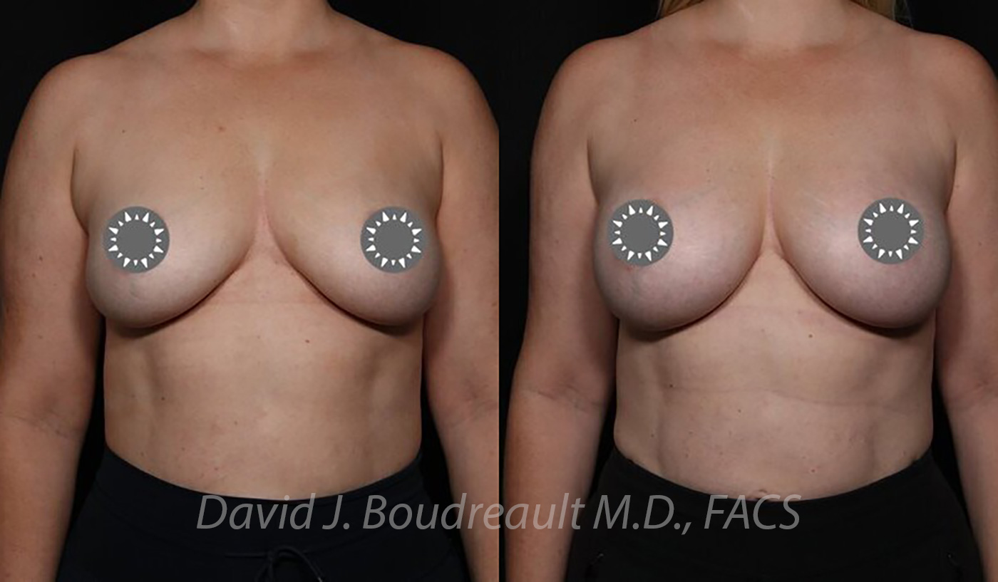 Breast Augmentation Before & After Image
