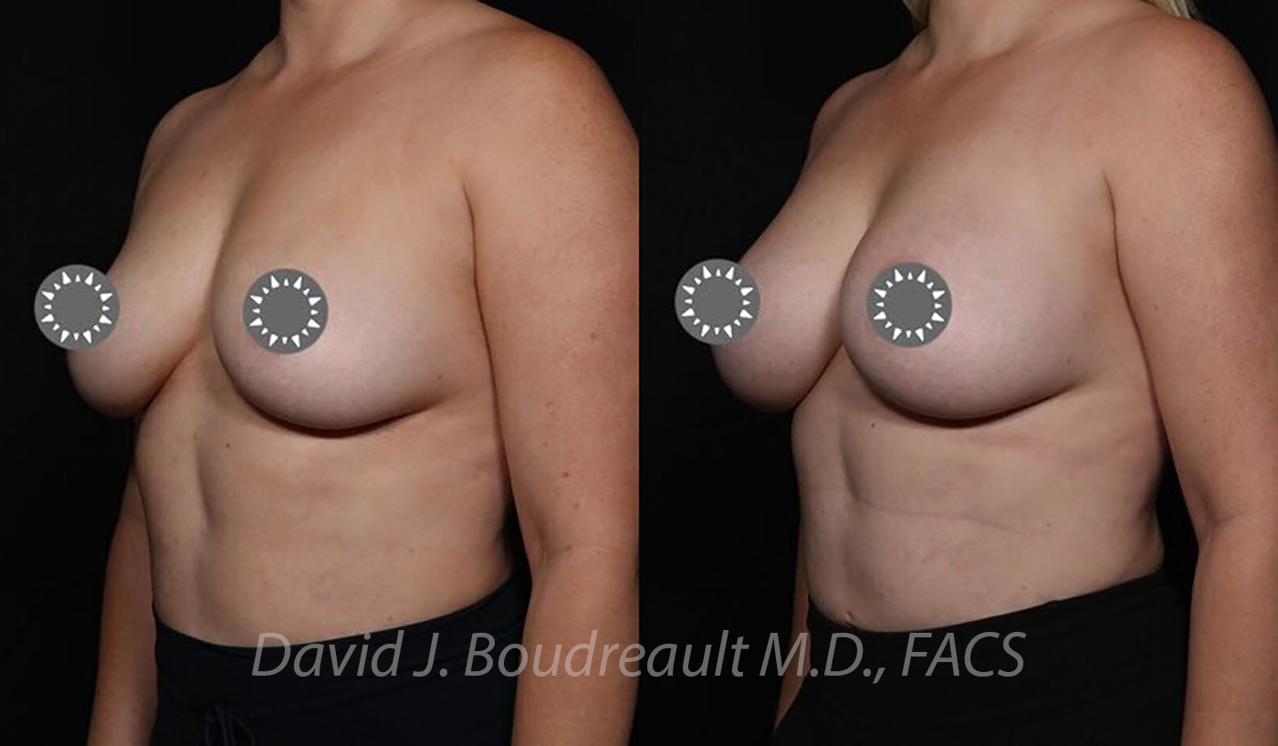 Breast Augmentation Before & After Image