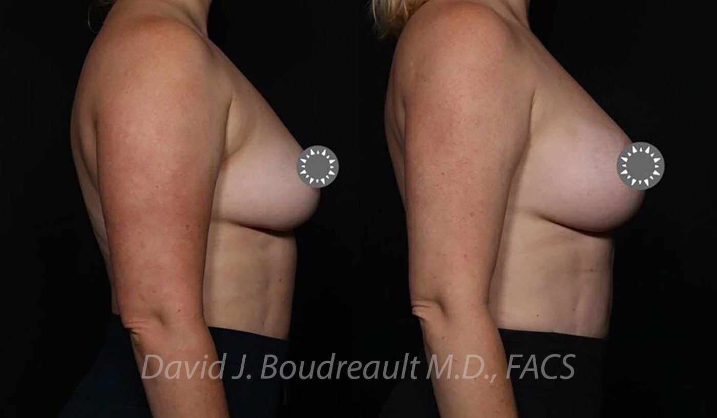 Breast Augmentation Before & After Image