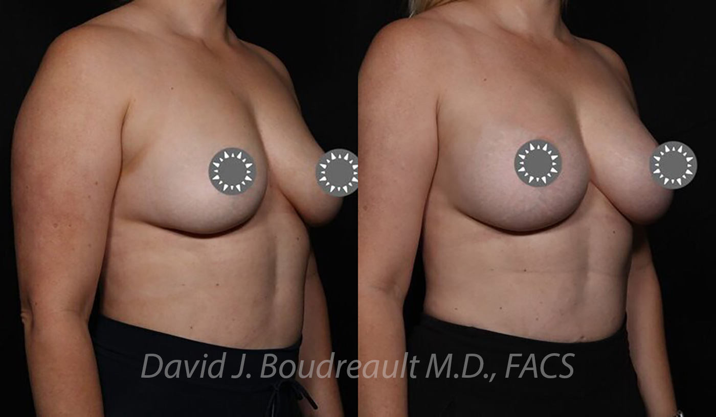 Breast Augmentation Before & After Image