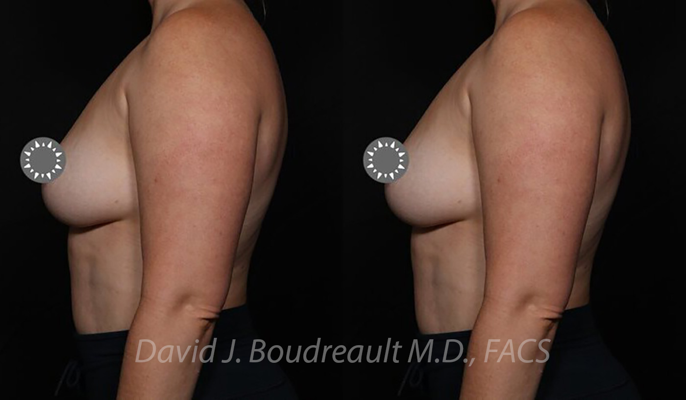 Breast Augmentation Before & After Image