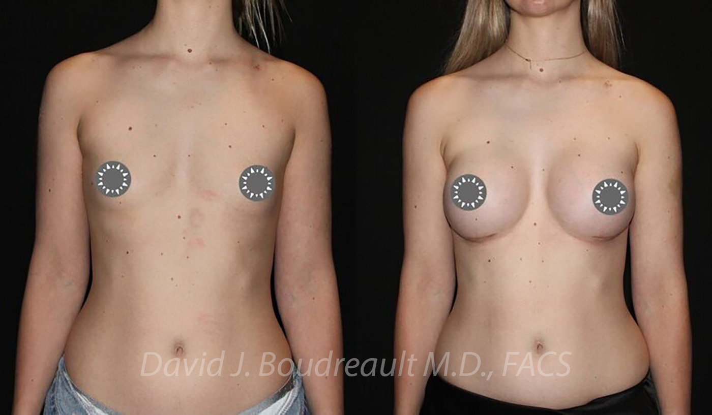 Breast Augmentation Before & After Image
