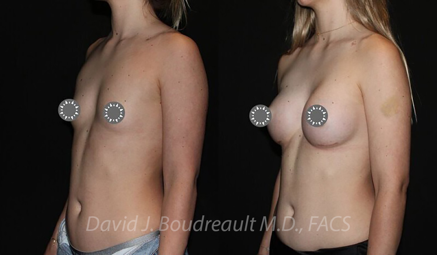 Breast Augmentation Before & After Image