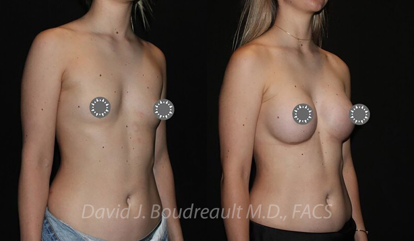 Breast Augmentation Before & After Image