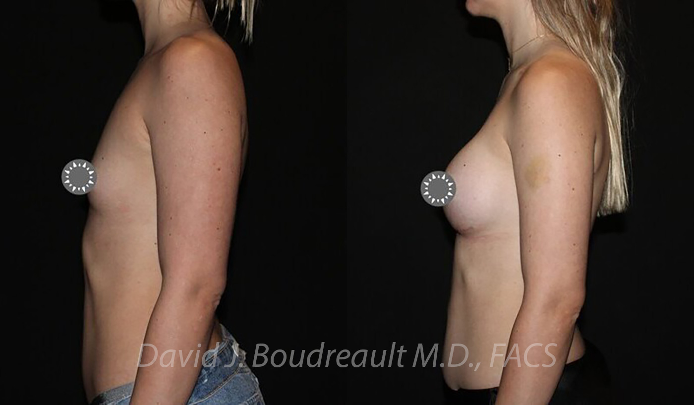 Breast Augmentation Before & After Image