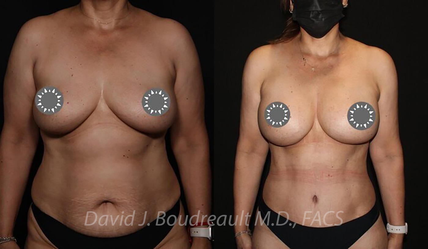 Breast Augmentation Before & After Image