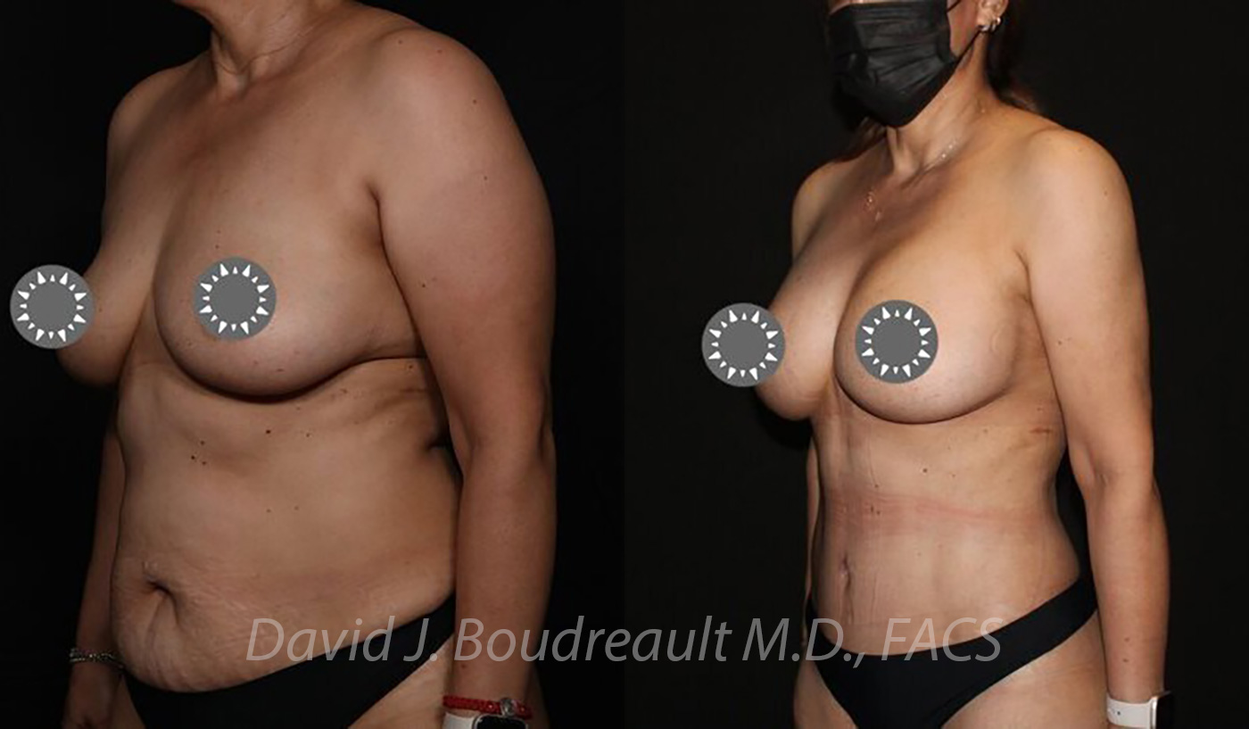 Breast Augmentation Before & After Image