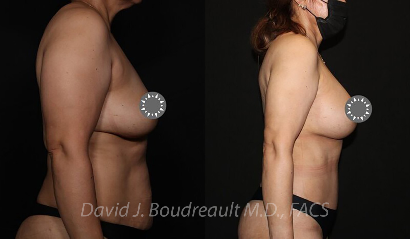 Breast Augmentation Before & After Image