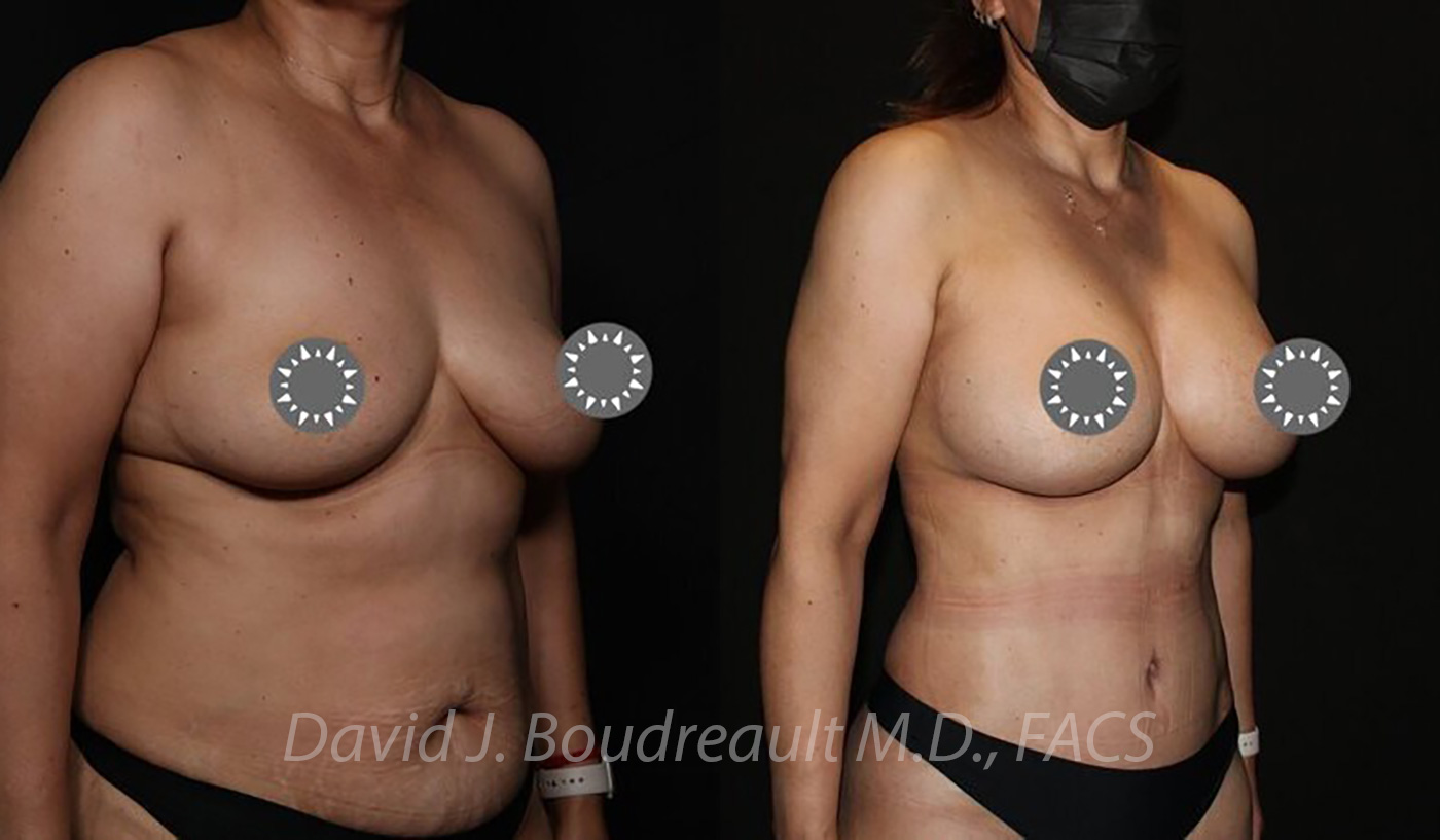 Breast Augmentation Before & After Image