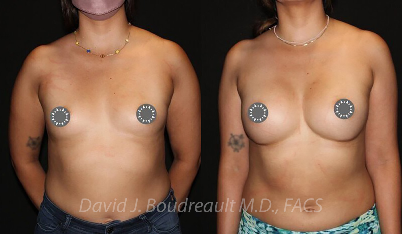 Breast Augmentation Before & After Image