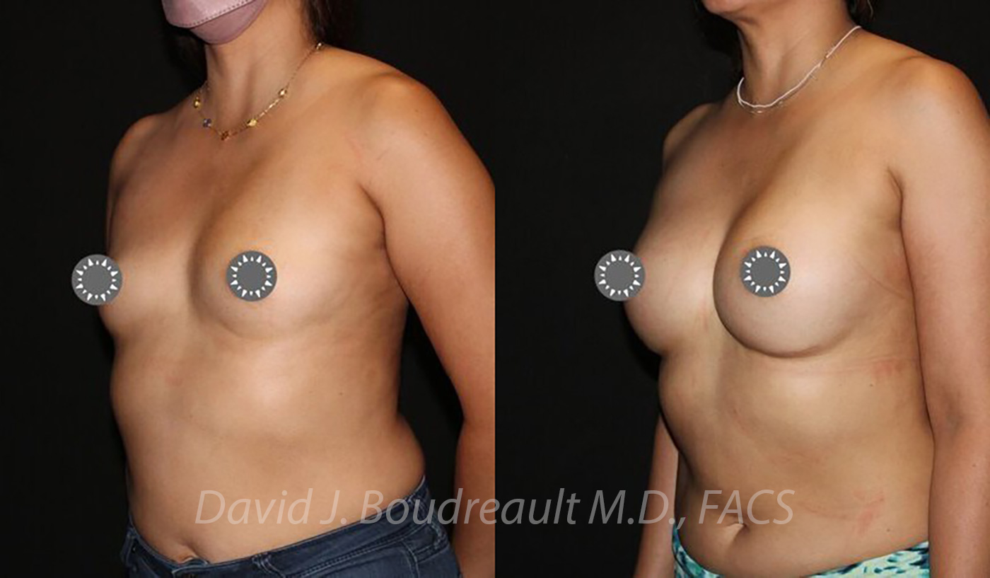 Breast Augmentation Before & After Image