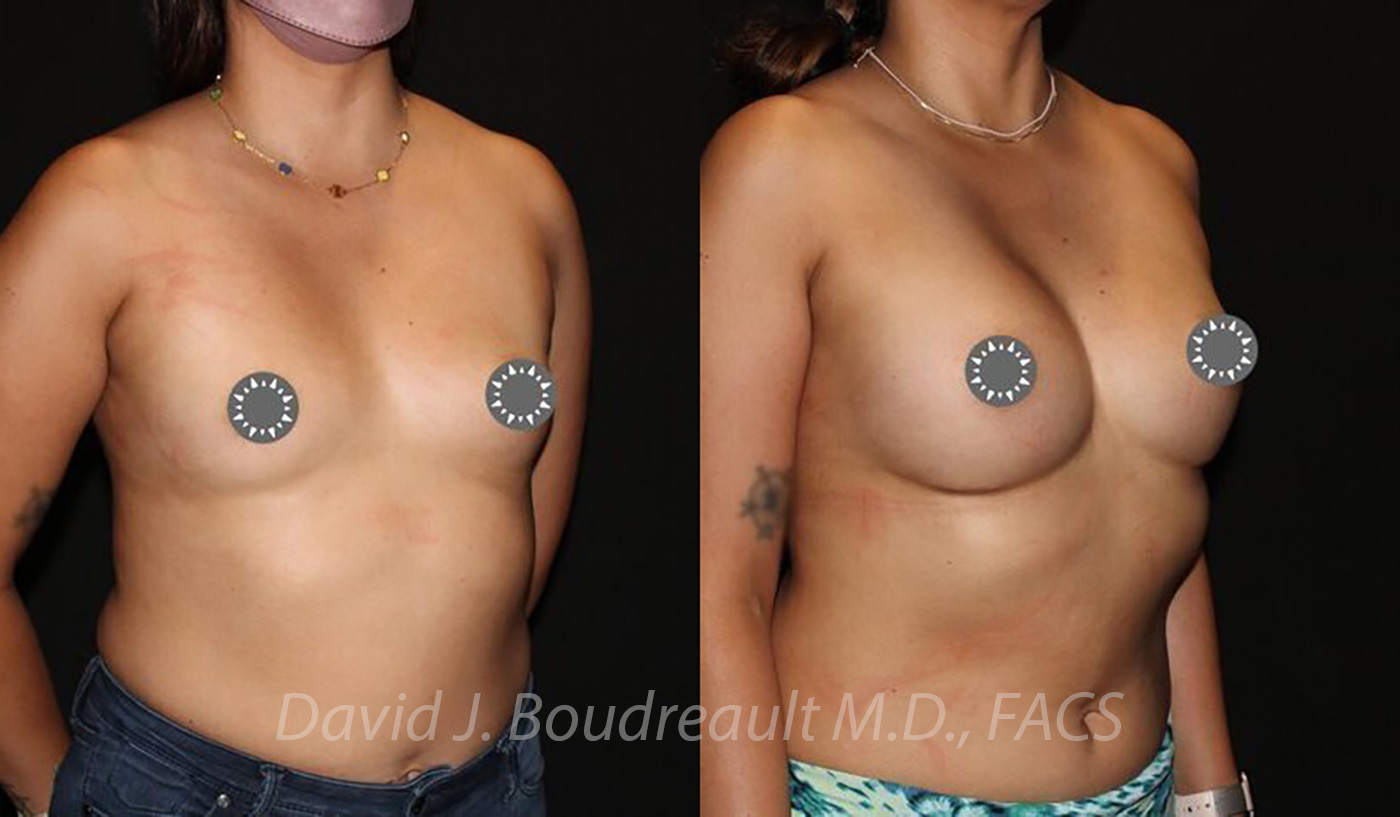 Breast Augmentation Before & After Image