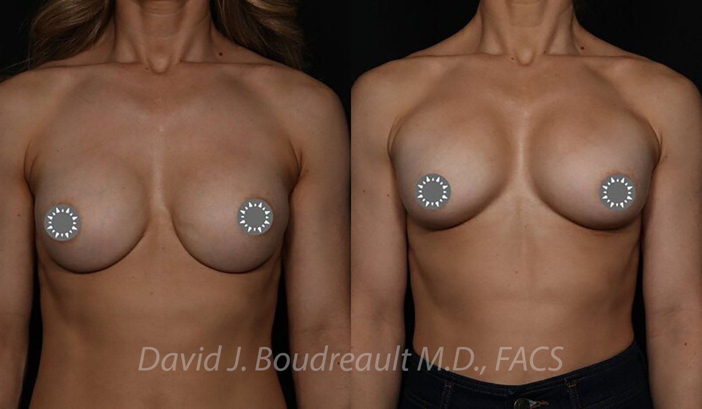 Breast Augmentation Before & After Image