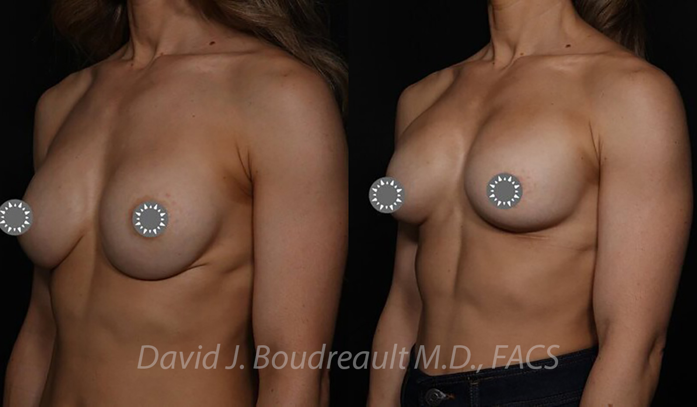 Breast Augmentation Before & After Image