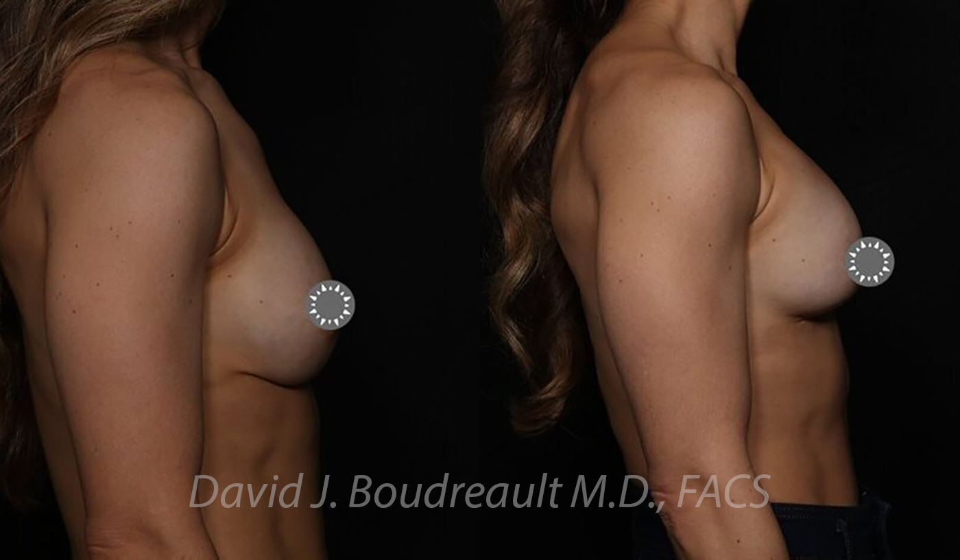 Breast Augmentation Before & After Image