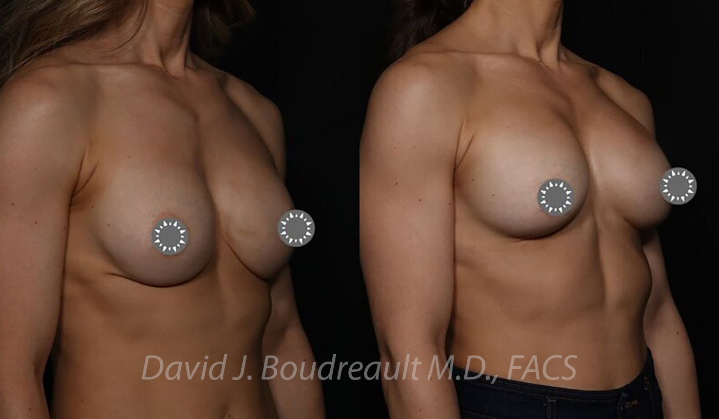 Breast Augmentation Before & After Image
